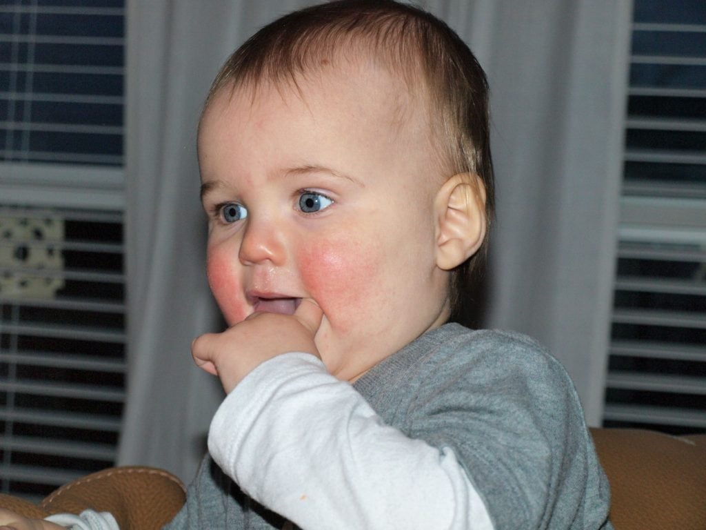 Luke-breastfeeding with MSPI